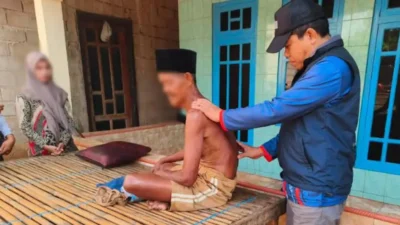 Kasus Kusta di Sumenep Turun Tajam, Kini Tinggal 150 Penderita